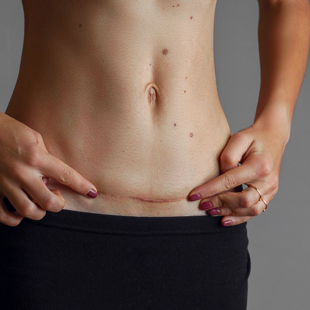 c Section Scars Defined By a Plastic Surgeon