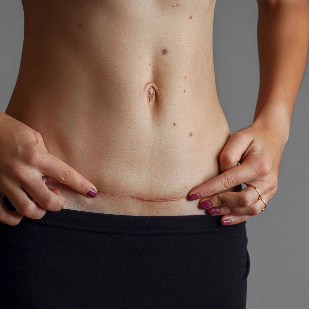 c Section Scars Defined By a Plastic Surgeon 
