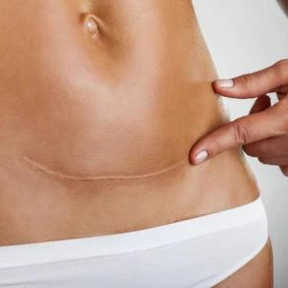 Caring for your C Section Scar 
